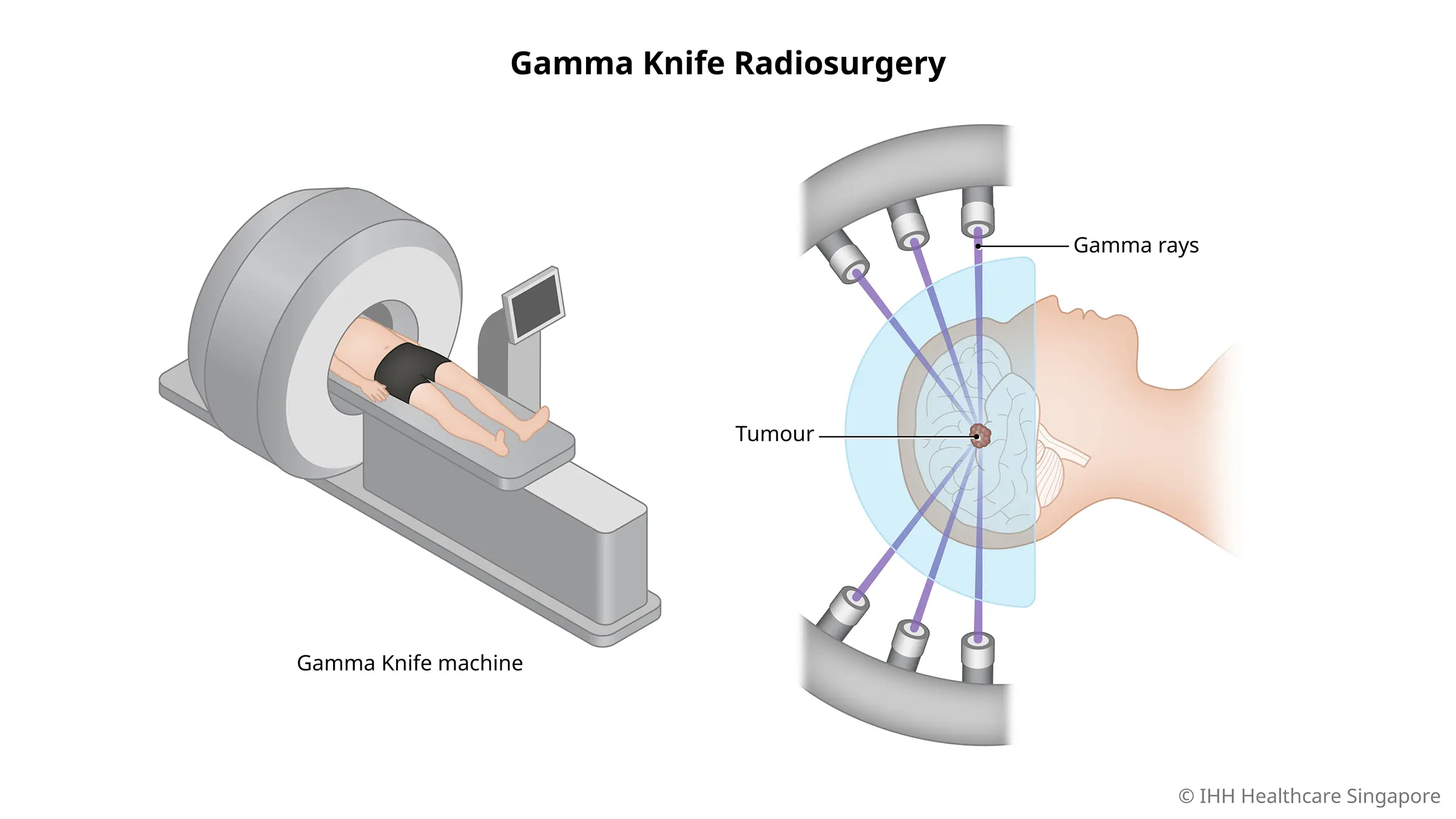 Understanding Gamma Knife Treatment: Benefits, Risks, and Recovery